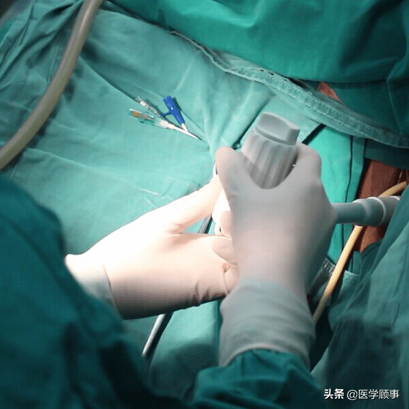 一次性使用无菌举宫器简介