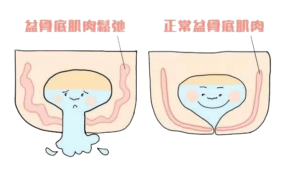 怎麼辦生完娃以後都不敢打噴嚏怕漏尿