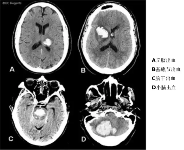 影像醫生必須掌握的頭顱ct解剖與常見出血梗死判讀