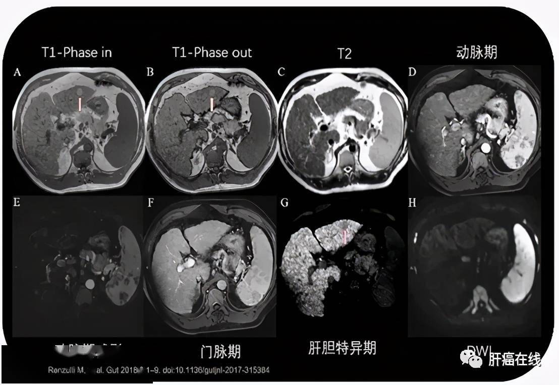 原發性肝癌癌前病變診療共識解讀_診斷