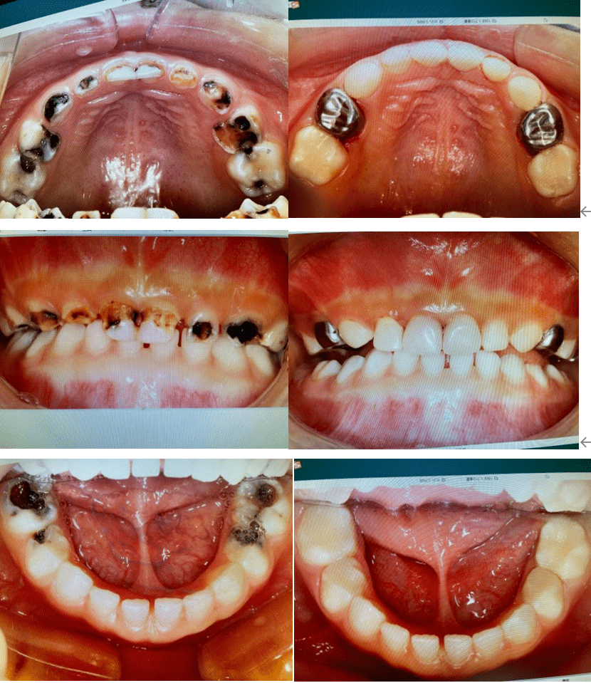 青岛妇儿医院城阳院区舒适化治疗解难题4岁女童14颗烂牙变白牙