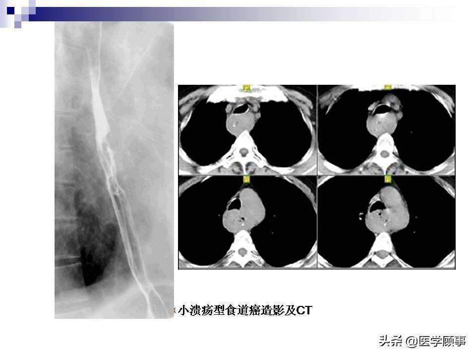 食道癌ct片子图解图片