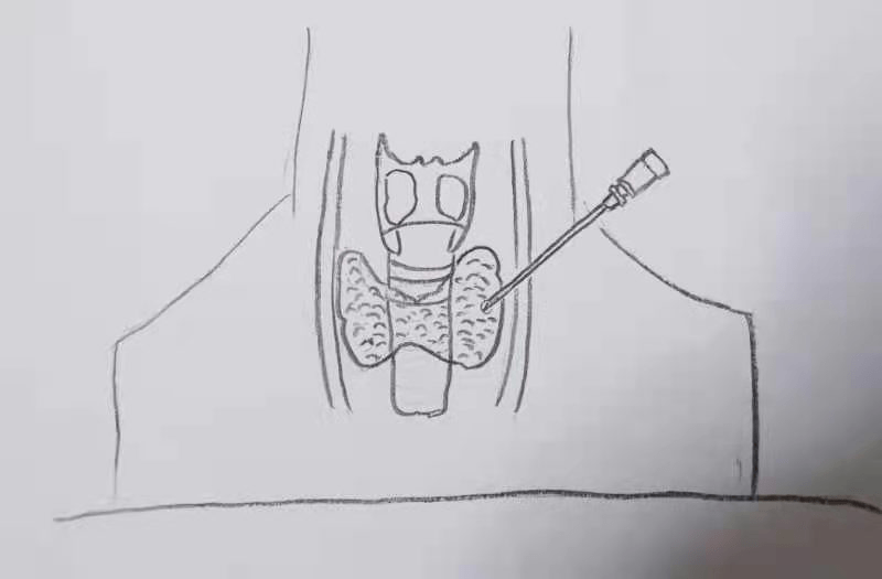 脖子上的"蝴蝶结"_甲状腺