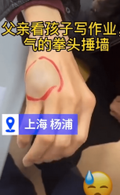 父亲辅导作业捶墙致手骨折!