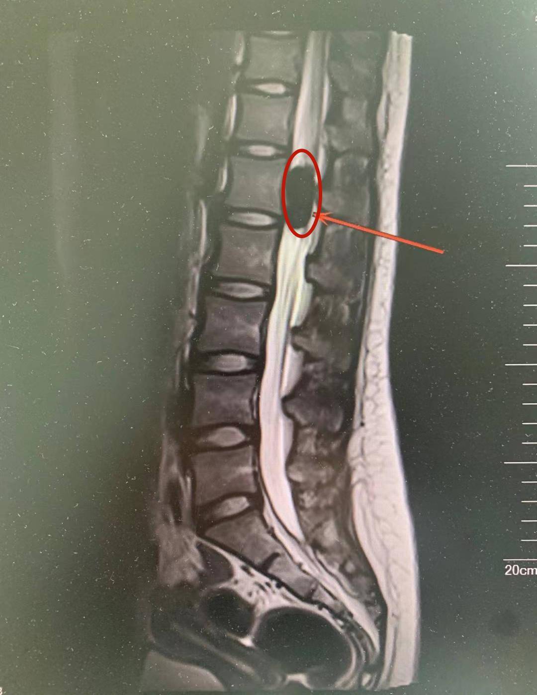 16岁女孩腿麻无法行走元凶竟是脊椎里长肿瘤