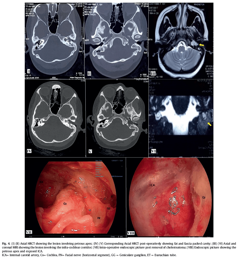 malleus, gl = glomus tympanicum, pr= promontory, f= facial nerve