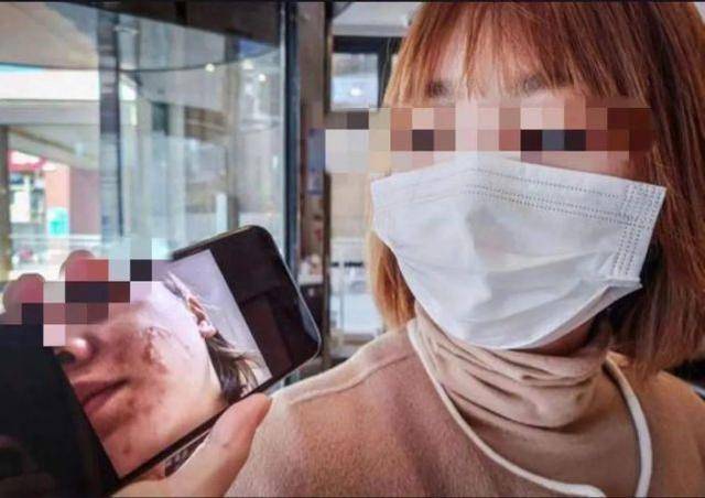 美容变毁容花近3万换回二度烫伤医美医院却回应属正常不良反应