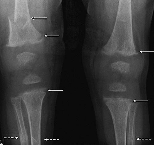 11种常见代谢性骨病的影像学表现 骨质疏松症