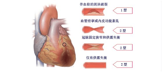 中年人要警惕急性冠脈綜合徵