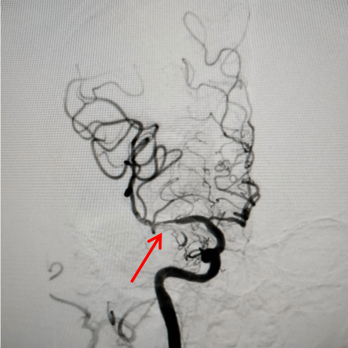 颈内动脉超大负荷量血栓栓塞取栓一例