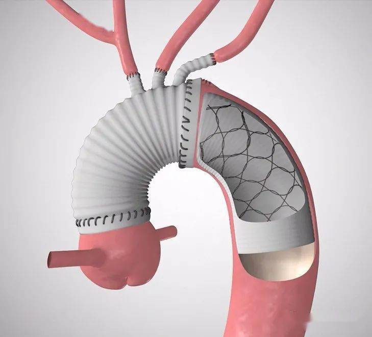 胸主动脉瘤介入支架图片
