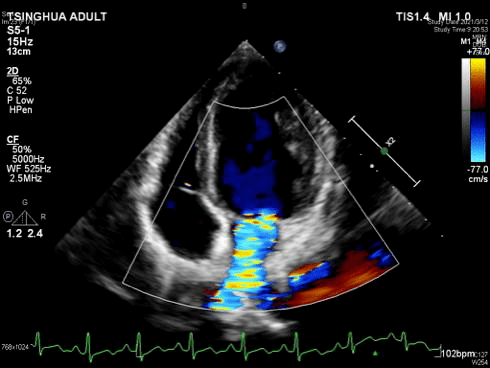 二尖瓣前后叶超声图片