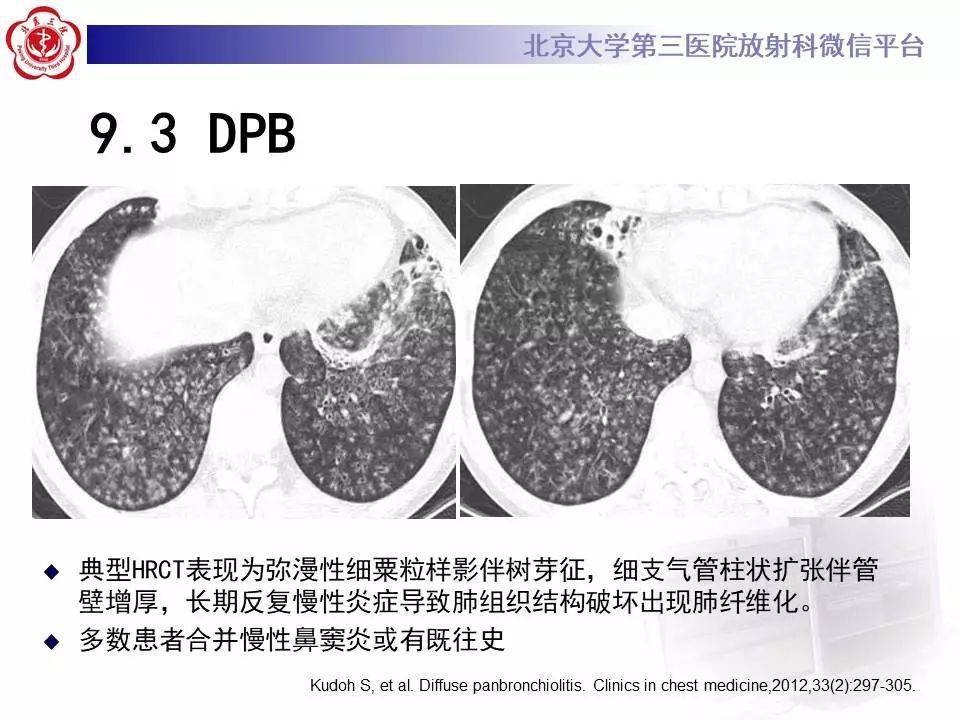 过敏性肺炎影像表现详细学习