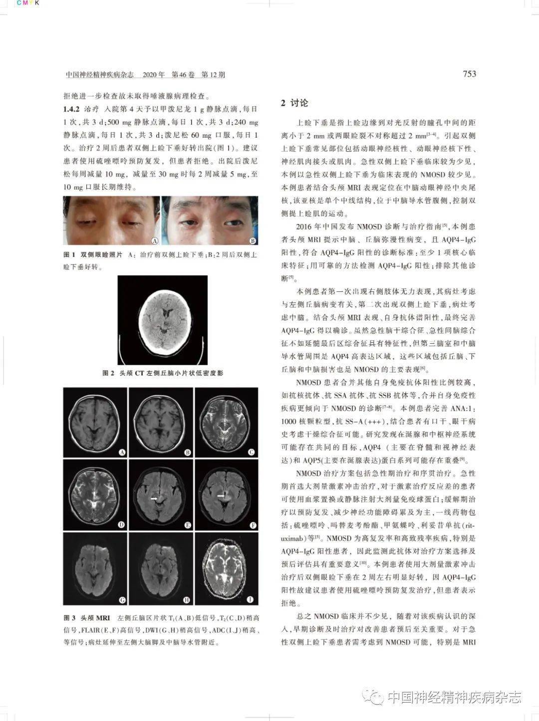 一種免疫介導的以視神經和脊髓受累為主的中樞神經系統炎性脫髓鞘疾病