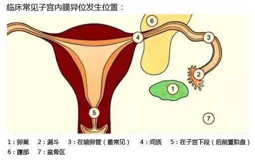 当子宫内膜在这些地方生长,浸润时,就开始作妖.