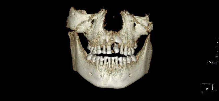 朱xx 20210417 多生牙cbct 131xxxx8088