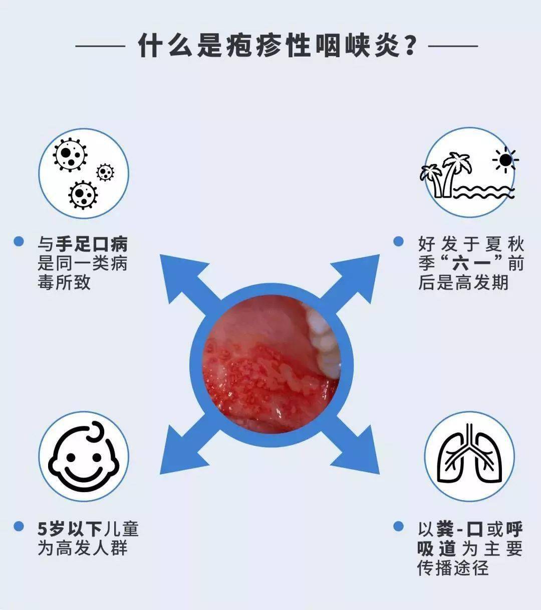 家長們皰疹性咽峽炎高發期請注意防範