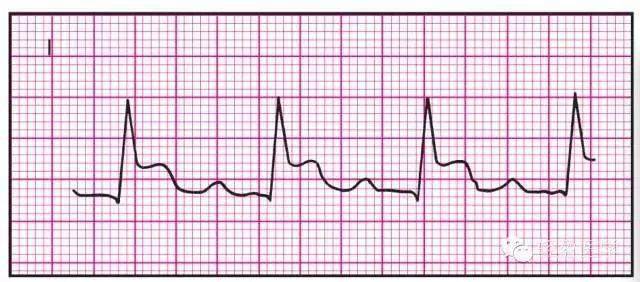 典型的急性侧壁心肌梗死是观察i,avl, v5,v6导联一度房室传导阻滞亦可