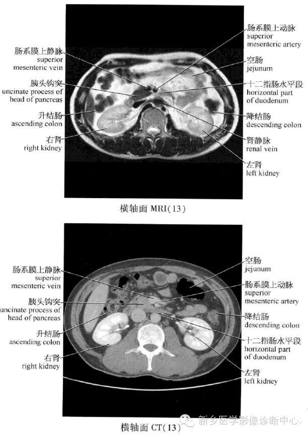 史上最全腹部橫斷位解剖詳細標註