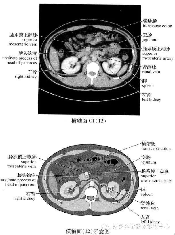 腹部肌肉ct解剖图片