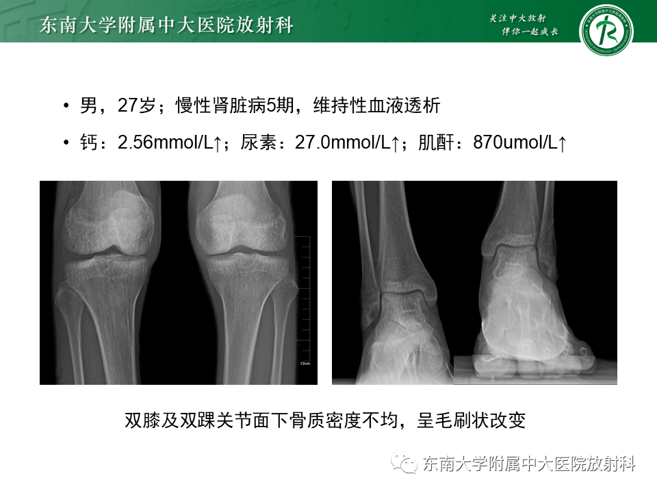 晨读结果公布20210422肌骨系统疾病肾性骨病透析相关淀粉样变dra
