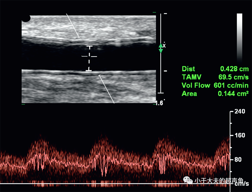 该如何用超声来评估动静脉瘘呢它能造瘘吗它成熟了吗它有狭窄吗