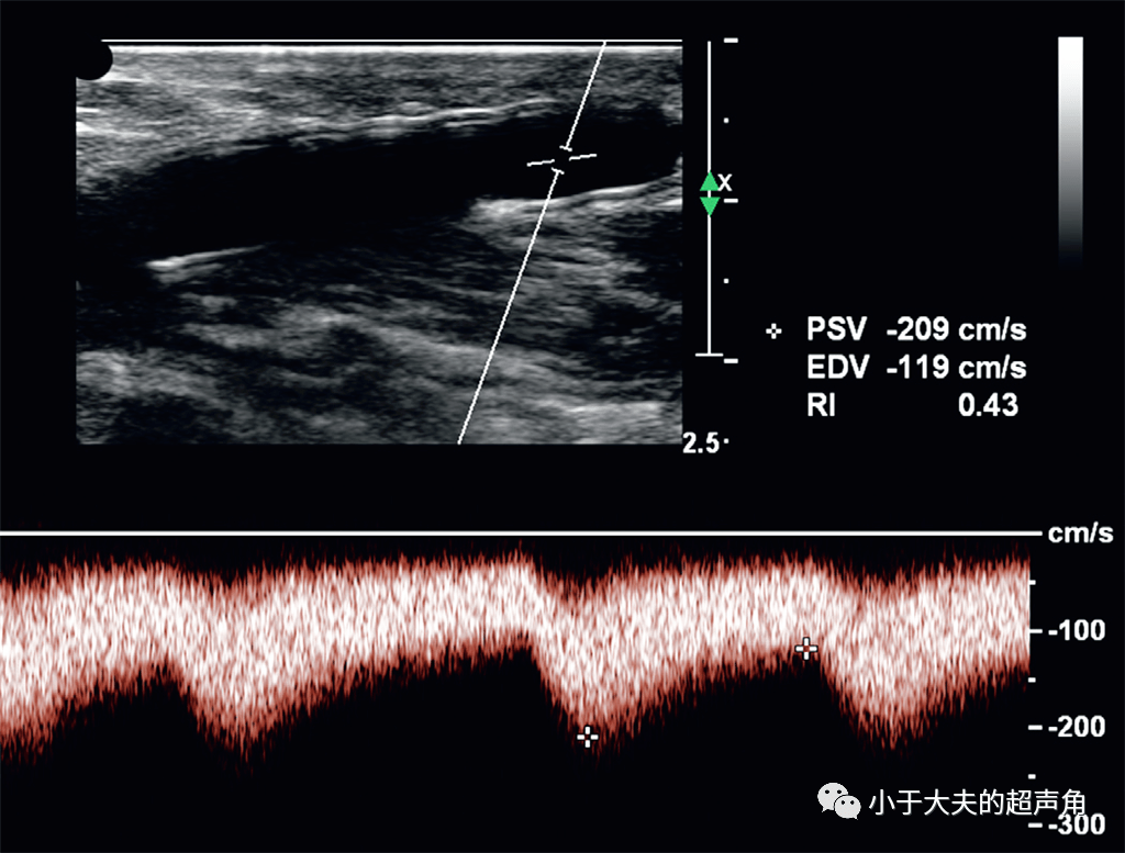 该如何用超声来评估动静脉瘘呢它能造瘘吗它成熟了吗它有狭窄吗
