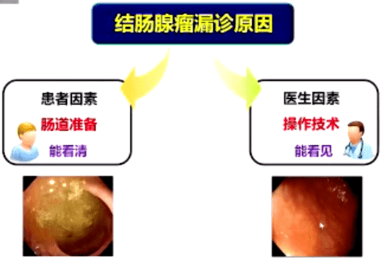 如何提高結腸鏡下腺瘤檢出率柏愚教授分享6點經驗太實用了