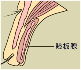 眼睛干涩考虑过睑板腺功能障碍吗