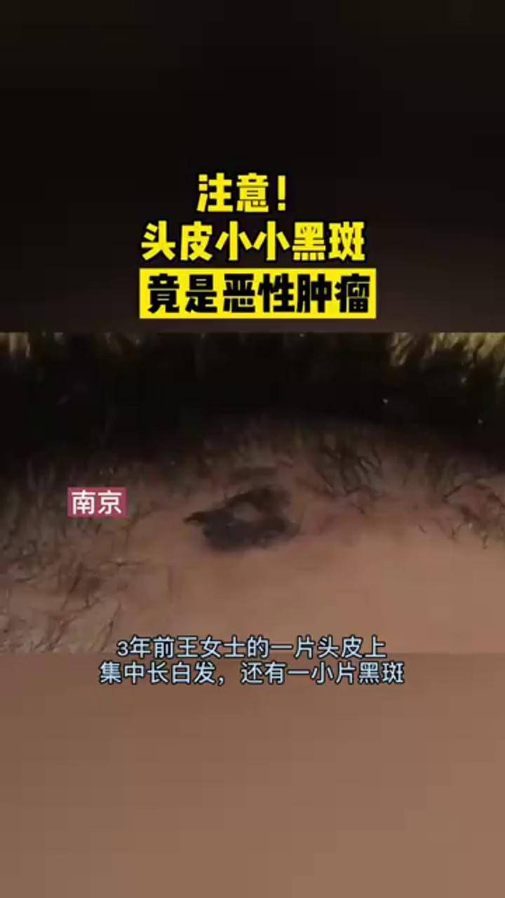 注意头皮小小黑斑竟是恶性肿瘤