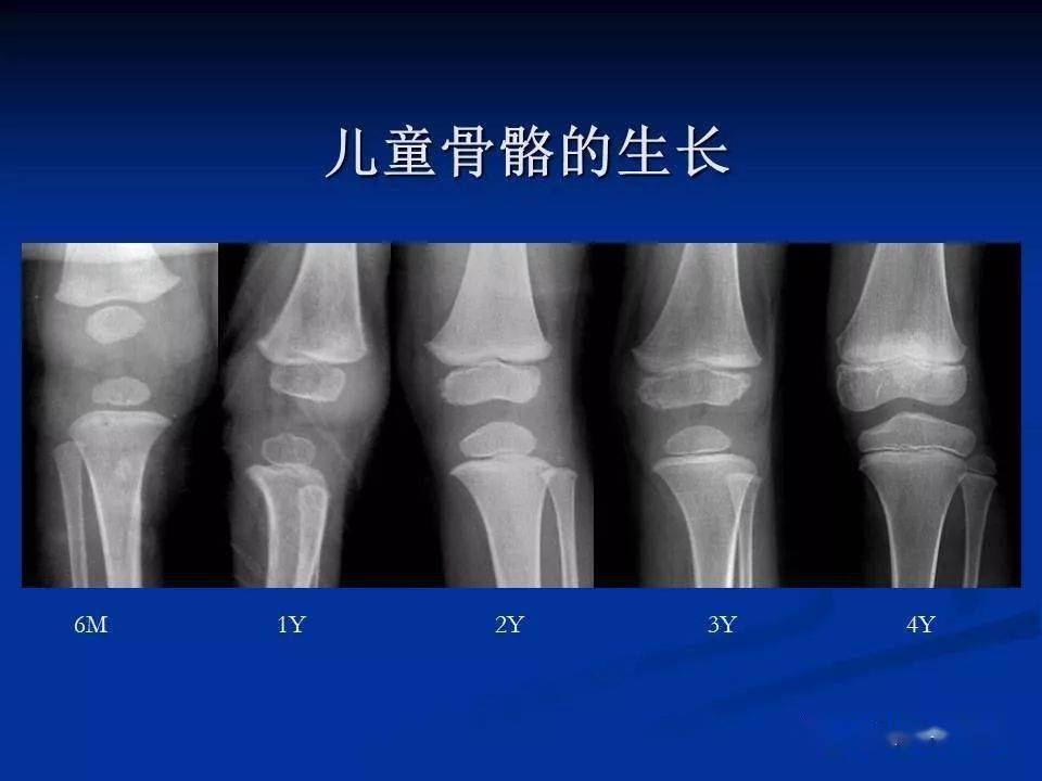 儿童长骨x线解剖图片