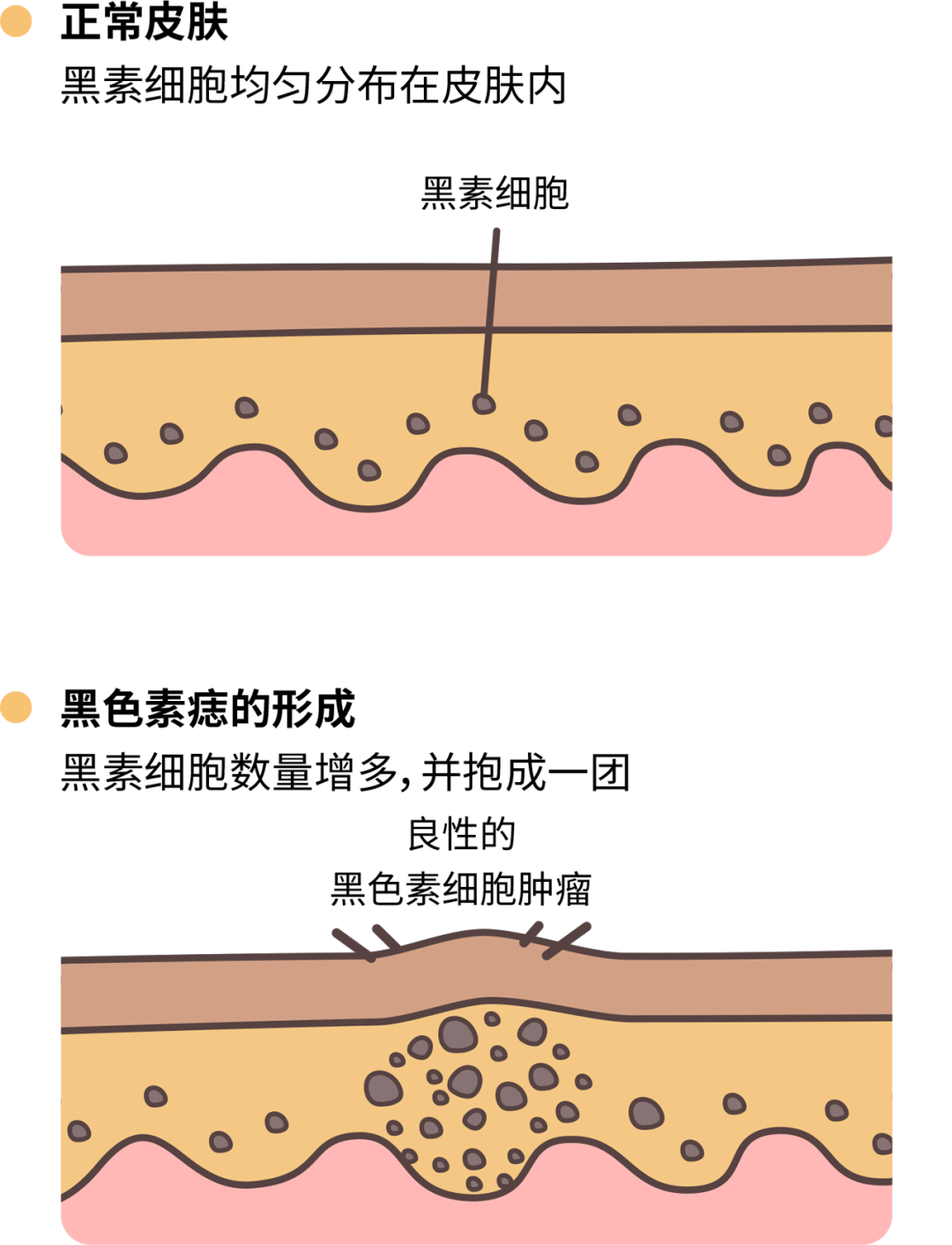 痣也可能会癌变！长在 3 个地方要注意
                
                 