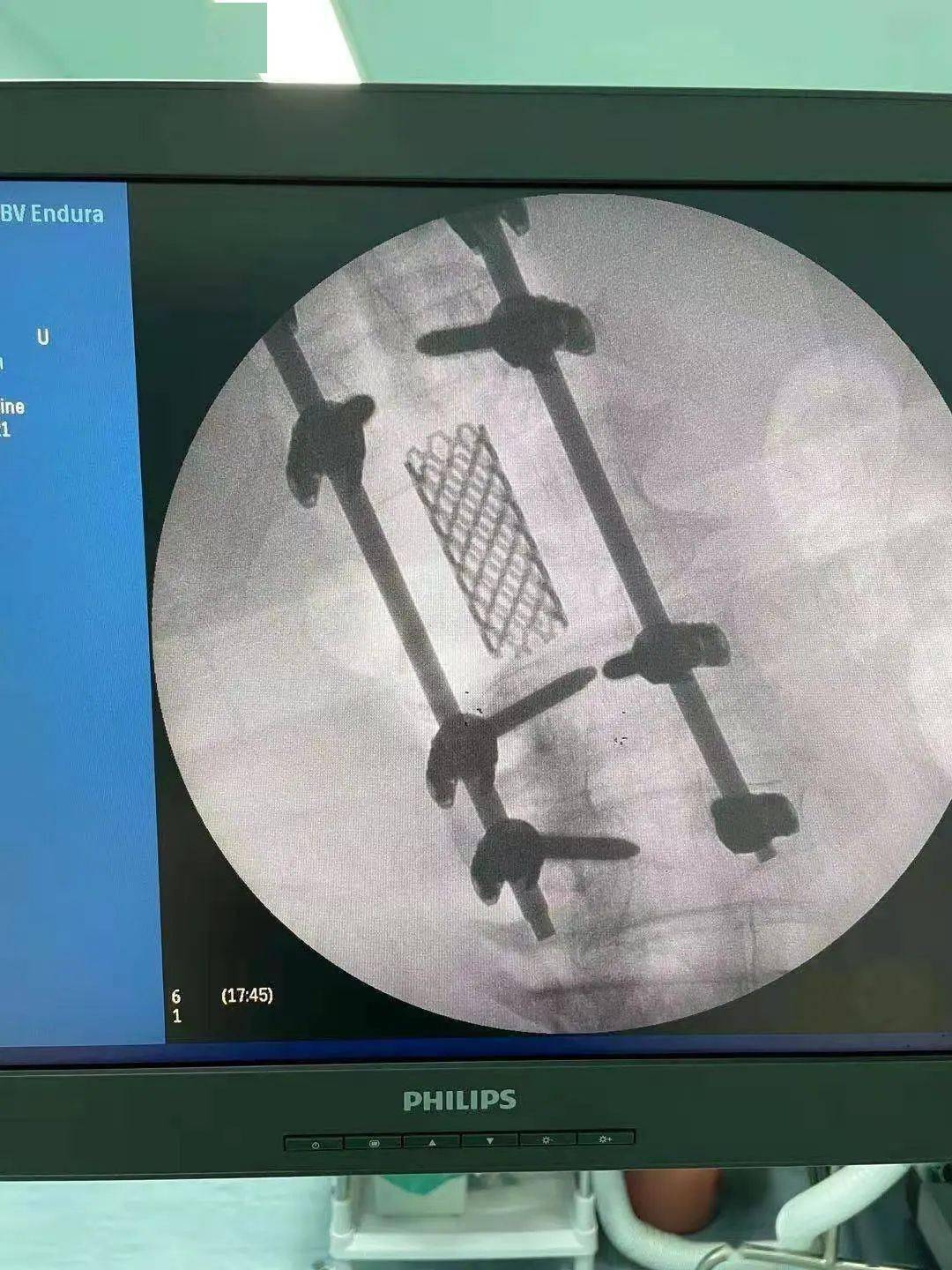 爆裂分离并累及终板,需要对椎体进行切除并行重建,加上本身的脊柱侧位