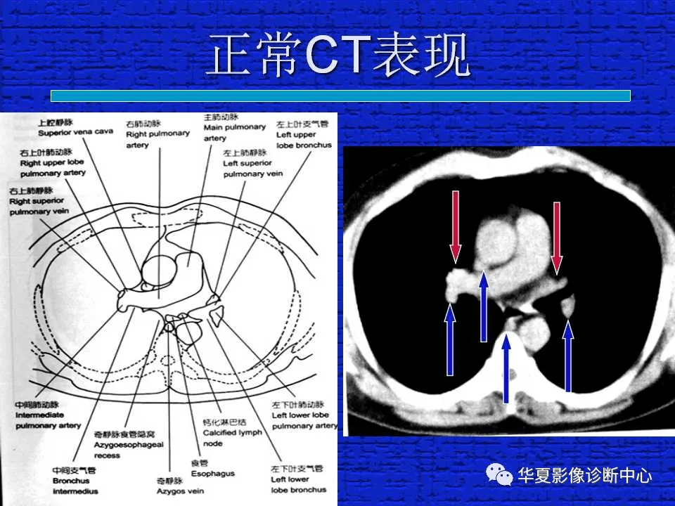 ct入门结合解剖谈正常胸部ct读片