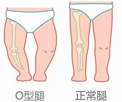 o型腿(膝关节内翻)的宝宝走路时双腿叉开,两腿间形状像个括号