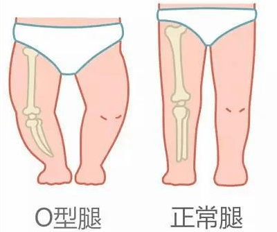 宝宝膝盖内翻图片图片