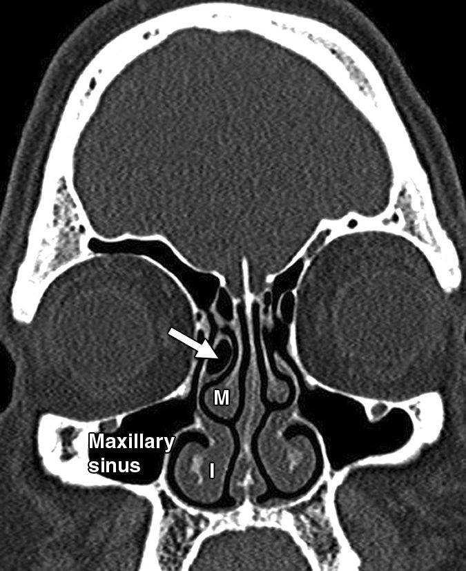 鼻竇和鼻腔解剖變異的ct