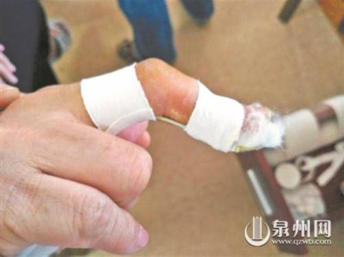 经常碰到打球后来就诊的病人,他们都是一进门就问:"医生,我手指头弯了