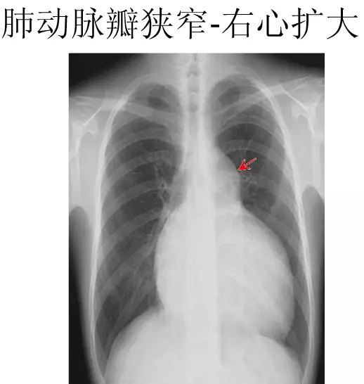 x线中的心影增大你真的会看吗