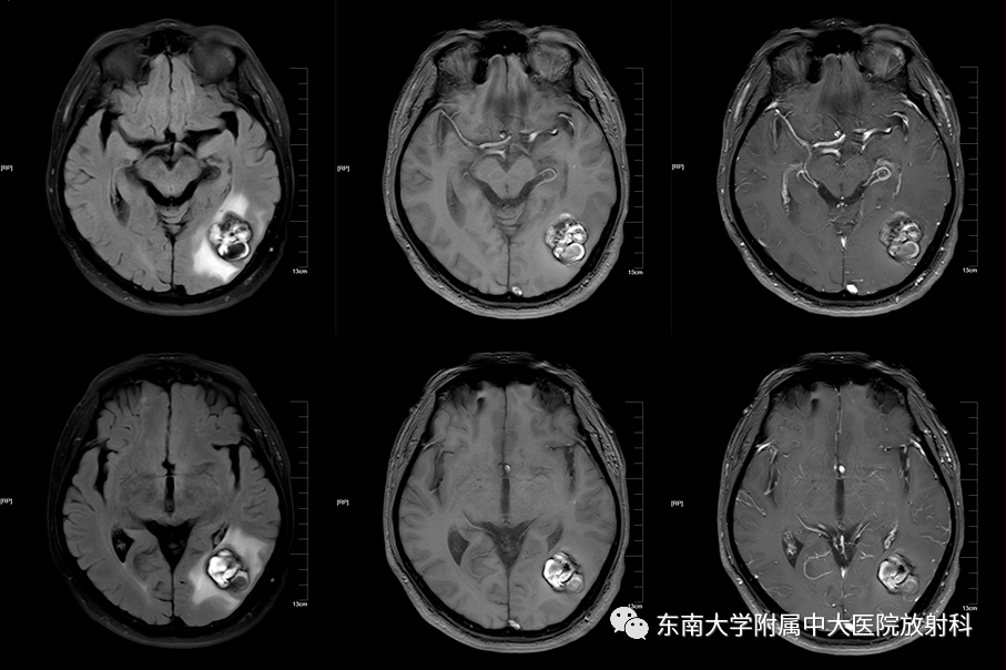 脑海绵状血管瘤10mm图片