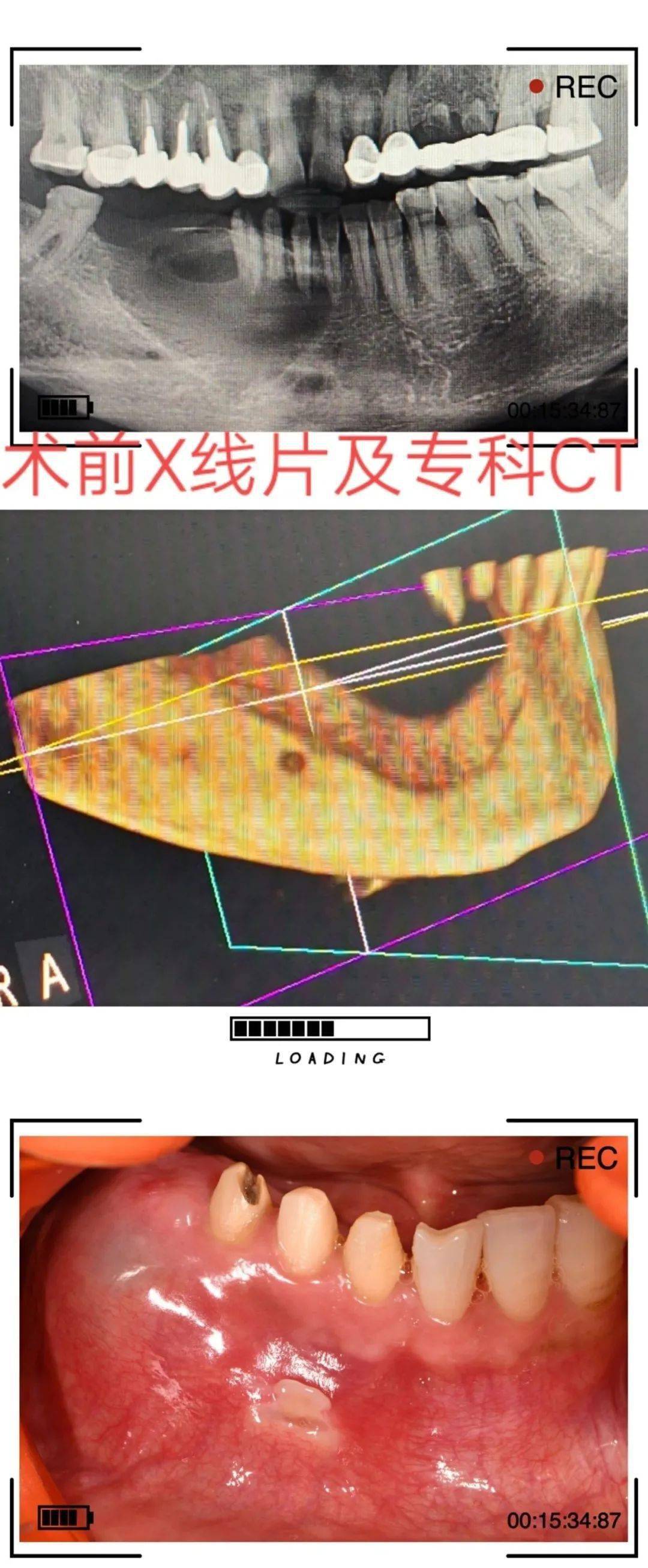 下颌骨缺损的修复旨在重建下颌骨的完整性 恢复下颌