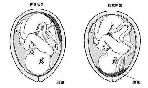 那胎盘前壁or前置胎盘