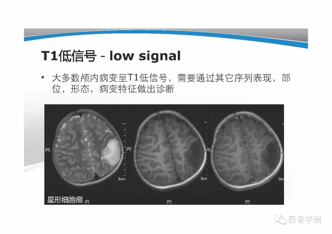 flair成像图片