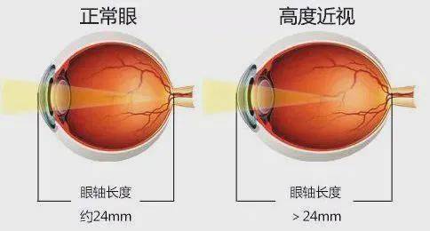 近视眼必看高度近视形成的3个阶段