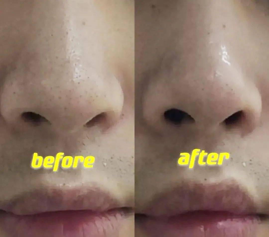 小视频里的暴力去黑头法,我试过居然真香了
