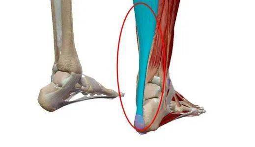 跟腱炎预防及康复治疗