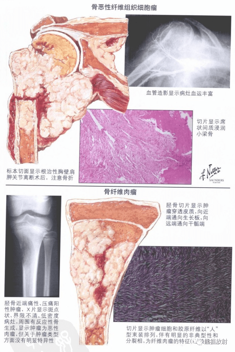 奈特图解丨骨骼肌肉系统肿瘤和相关瘤样病变