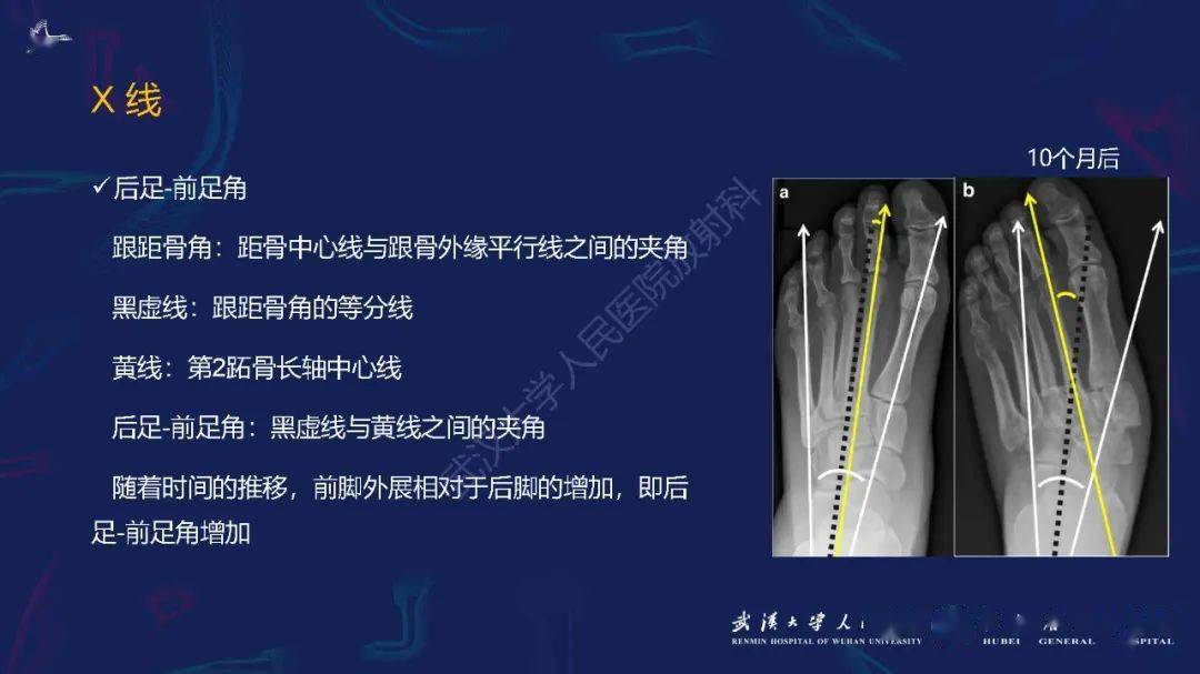 夏科氏足影像诊断