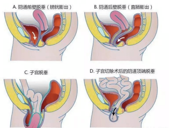 带您全面了解国内先进妇科微创手术—阴式妇科手术