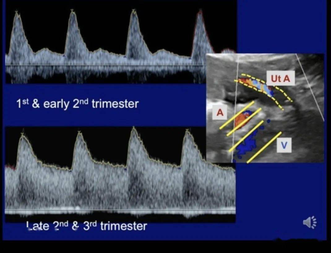 通俗谈谈产科多普勒